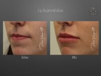 lip augmentation before and after