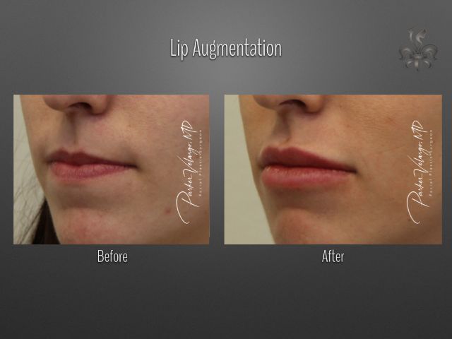 lip augmentation before and after