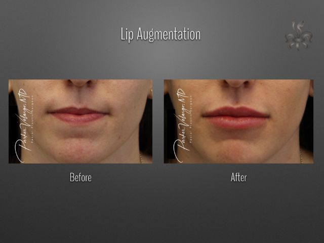 lip augmentation before and after
