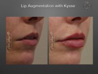 lip augmentation before and after