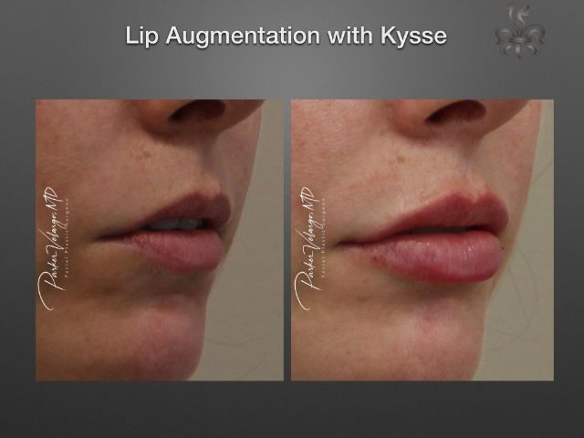 lip augmentation before and after