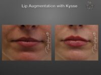 lip augmentation before and after