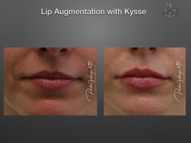 lip augmentation before and after