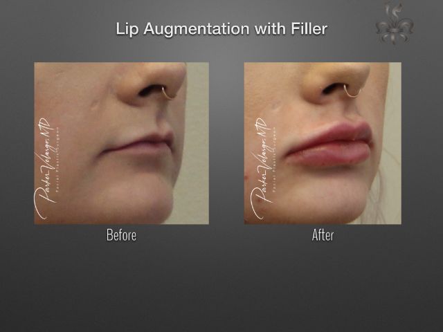 lip augmentation before and after