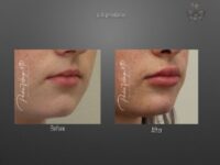 lip augmentation before and after