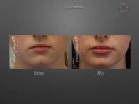 lip augmentation before and after