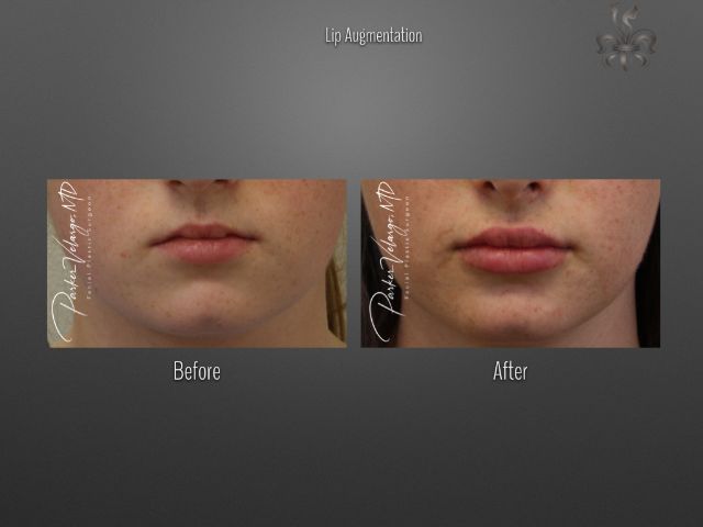 lip augmentation before and after