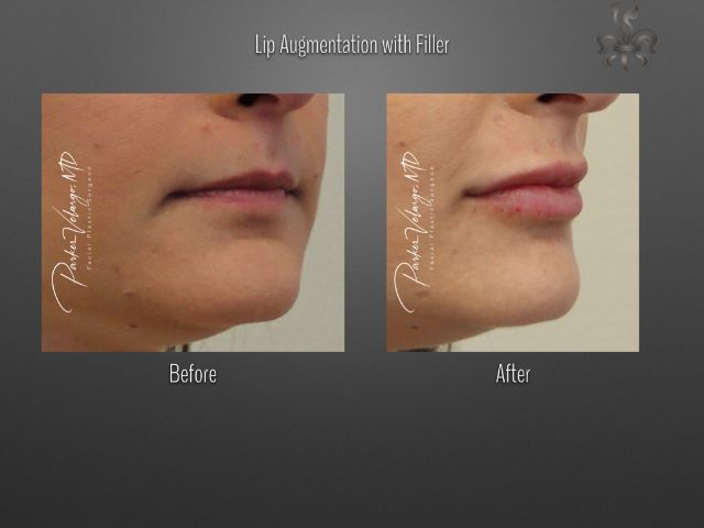 lip augmentation before and after