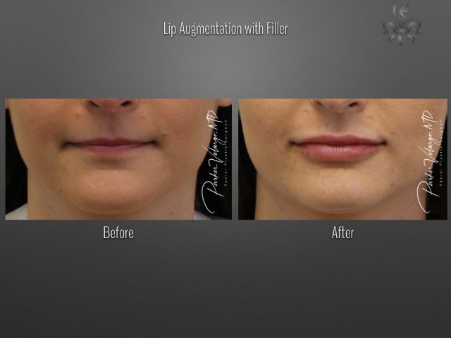lip augmentation before and after