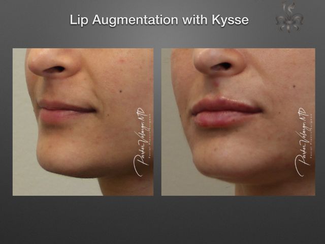 lip augmentation before and after