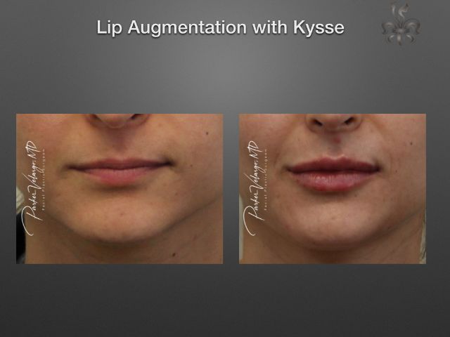 lip augmentation before and after