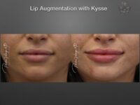 lip augmentation before and after