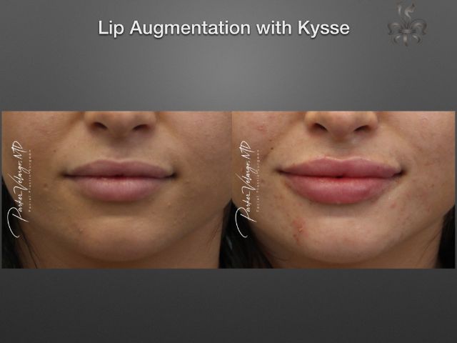 lip augmentation before and after