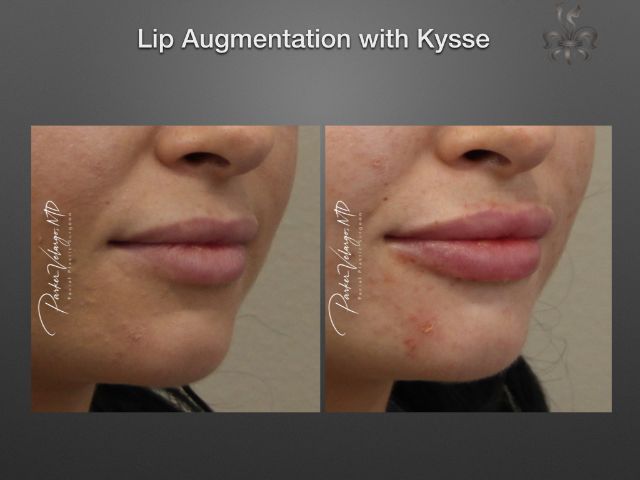 lip augmentation before and after