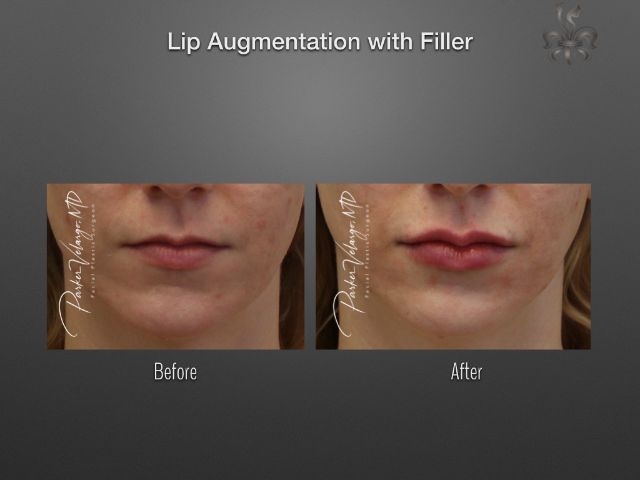 lip augmentation before and after