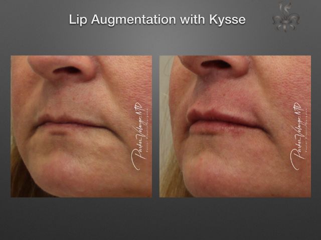 lip augmentation before and after