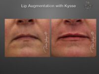 lip augmentation before and after