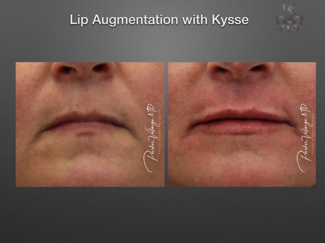 lip augmentation before and after