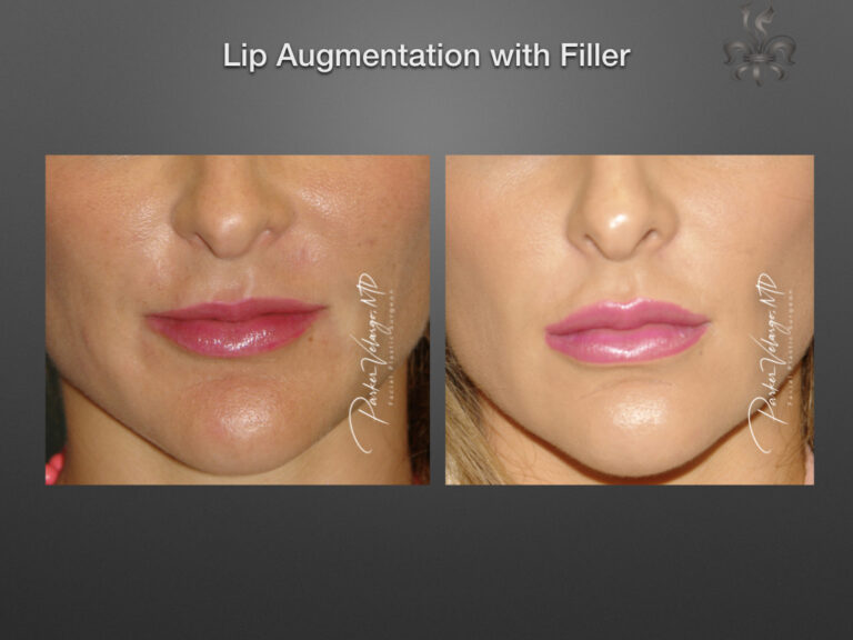 lip augmentation before & after