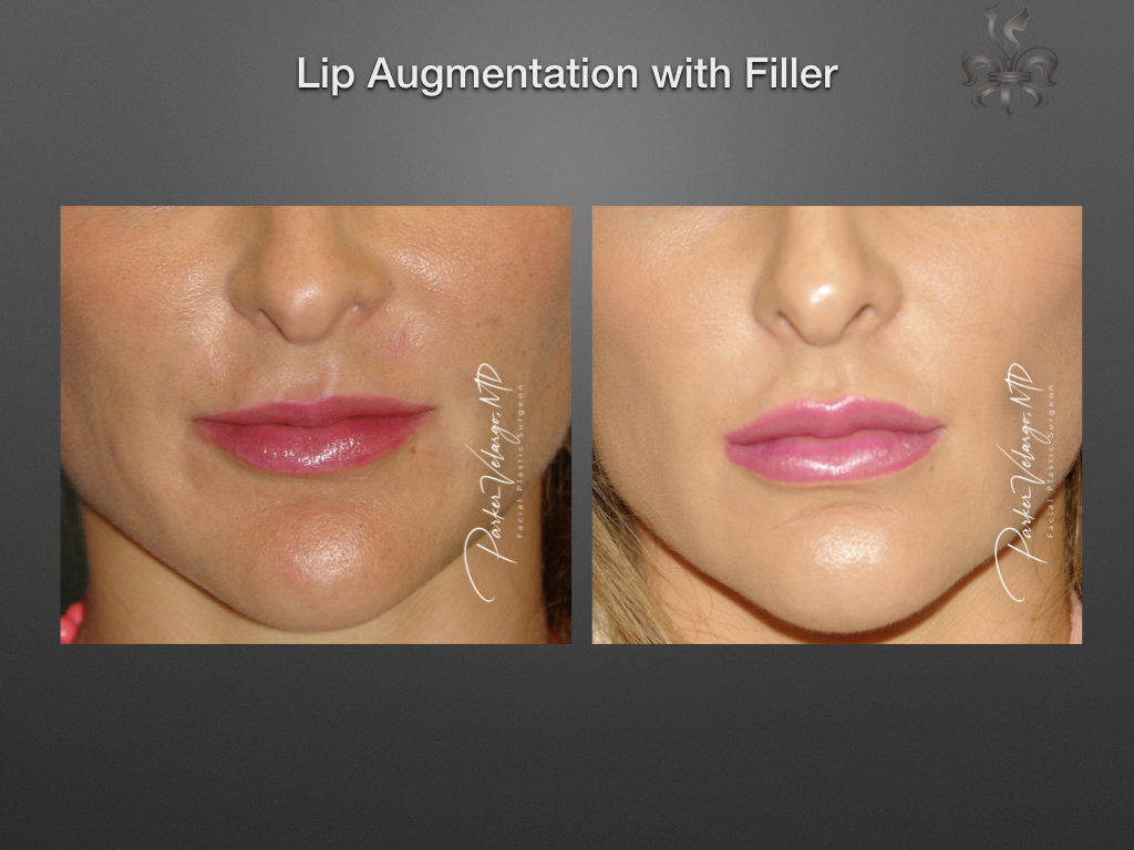 lip augmentation before & after