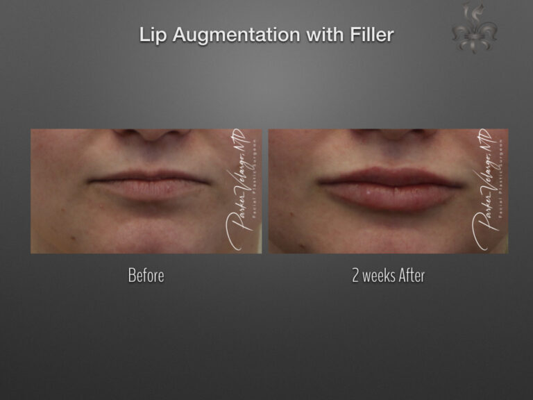 lip augmentation before & after