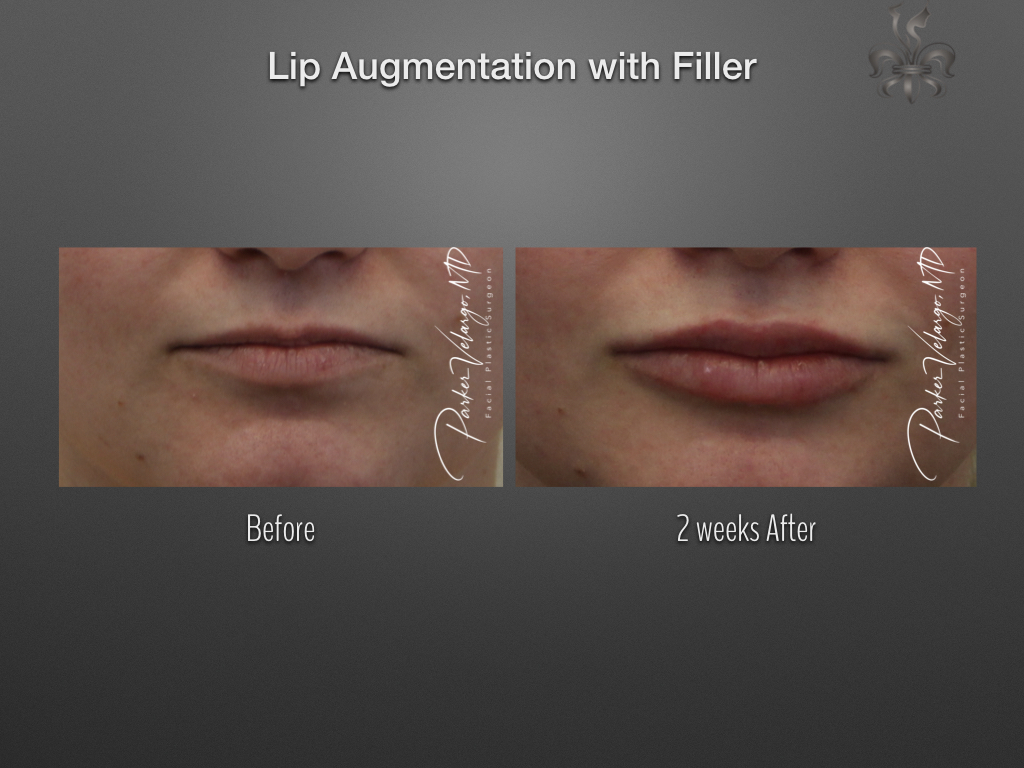 lip augmentation before & after