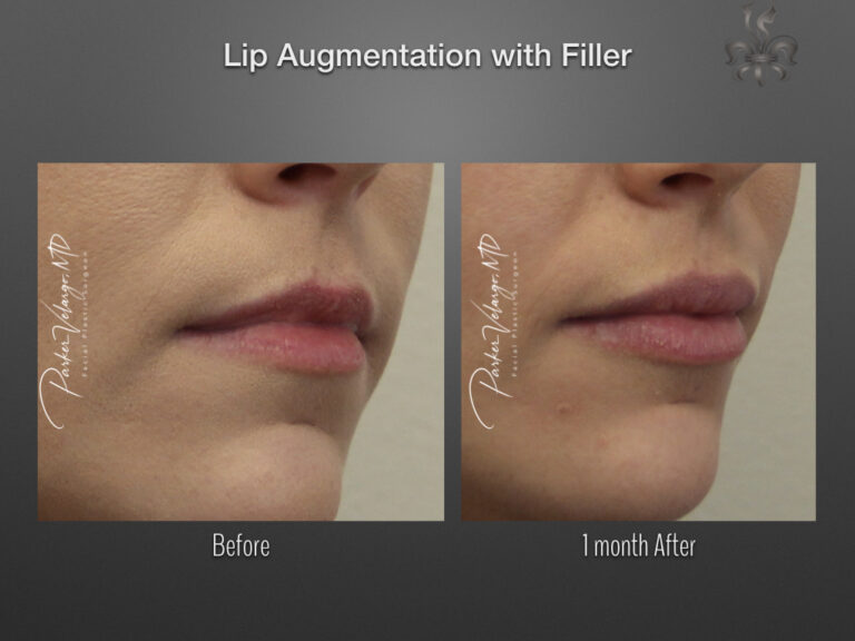 lip augmentation before & after
