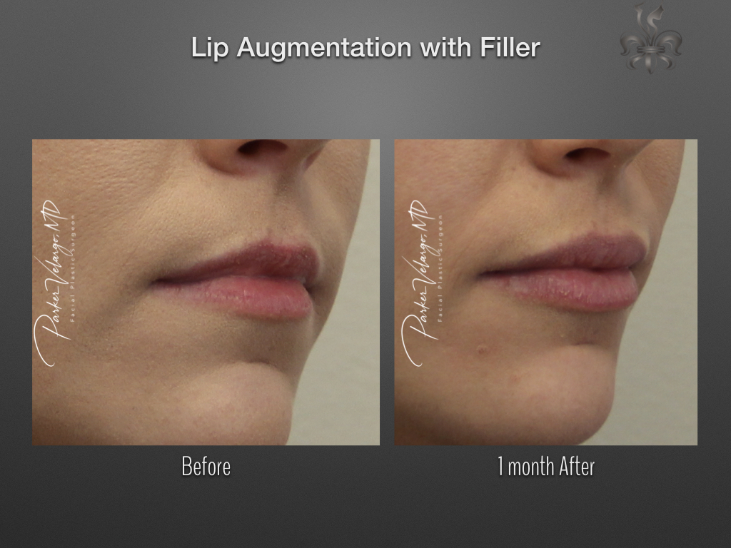 lip augmentation before & after