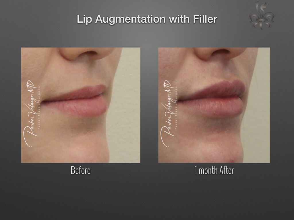 lip augmentation before & after