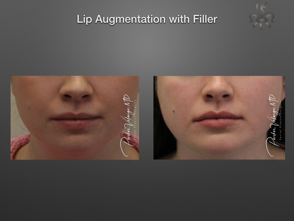 lip augmentation before & after