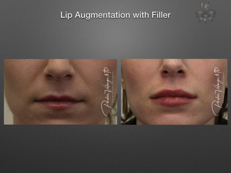 lip augmentation before & after
