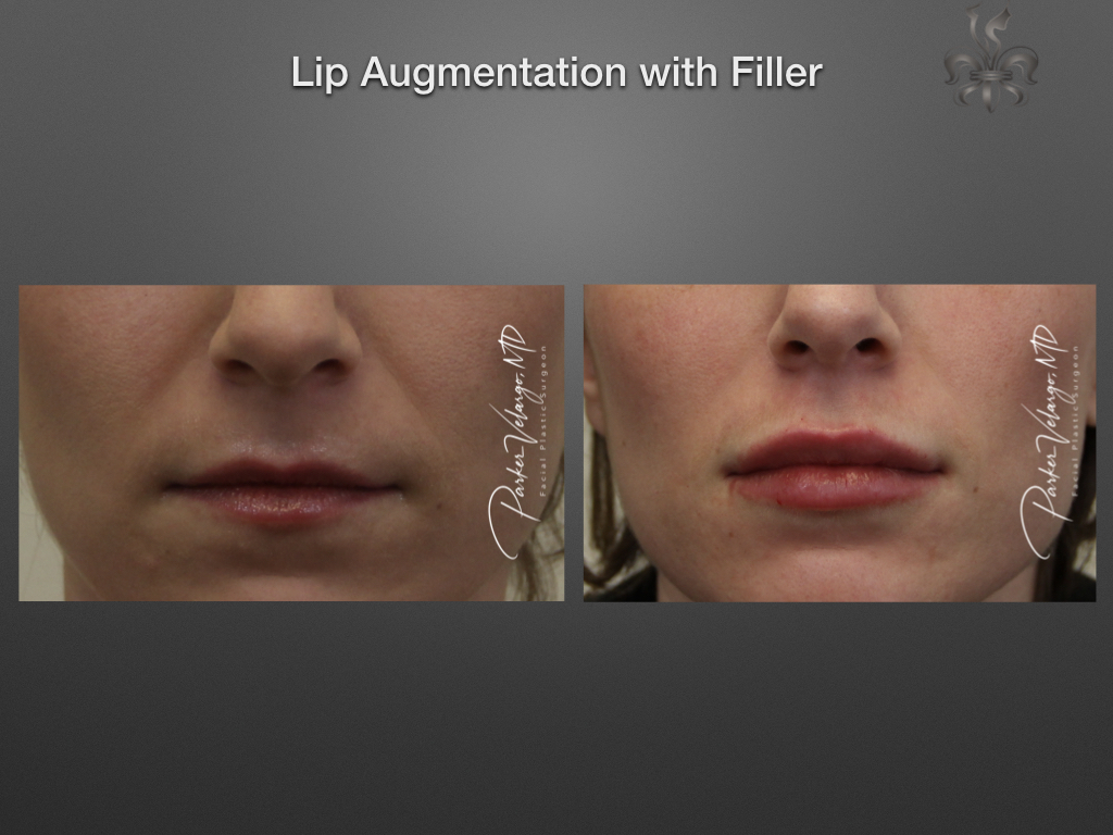 lip augmentation before & after