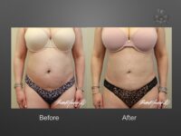 liposuction before and after