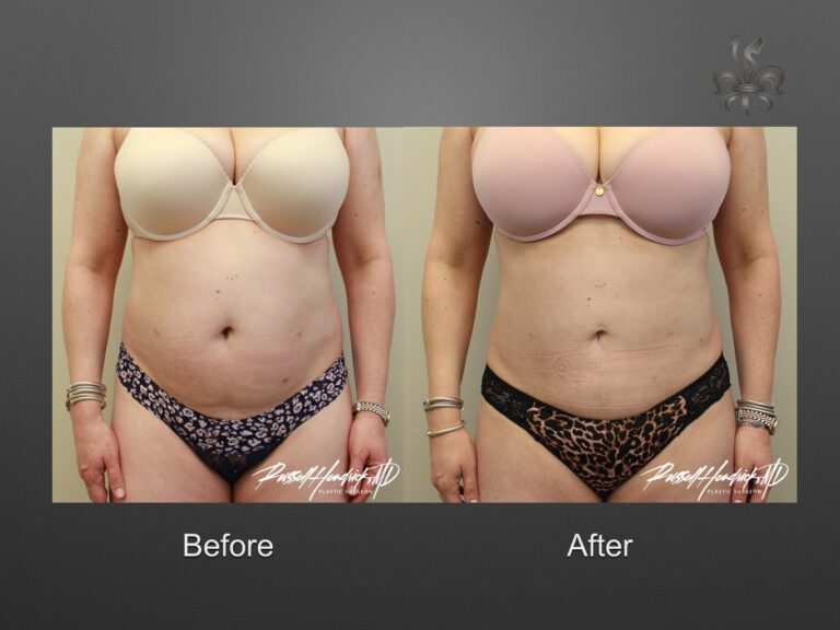 liposuction before and after