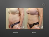 liposuction before and after