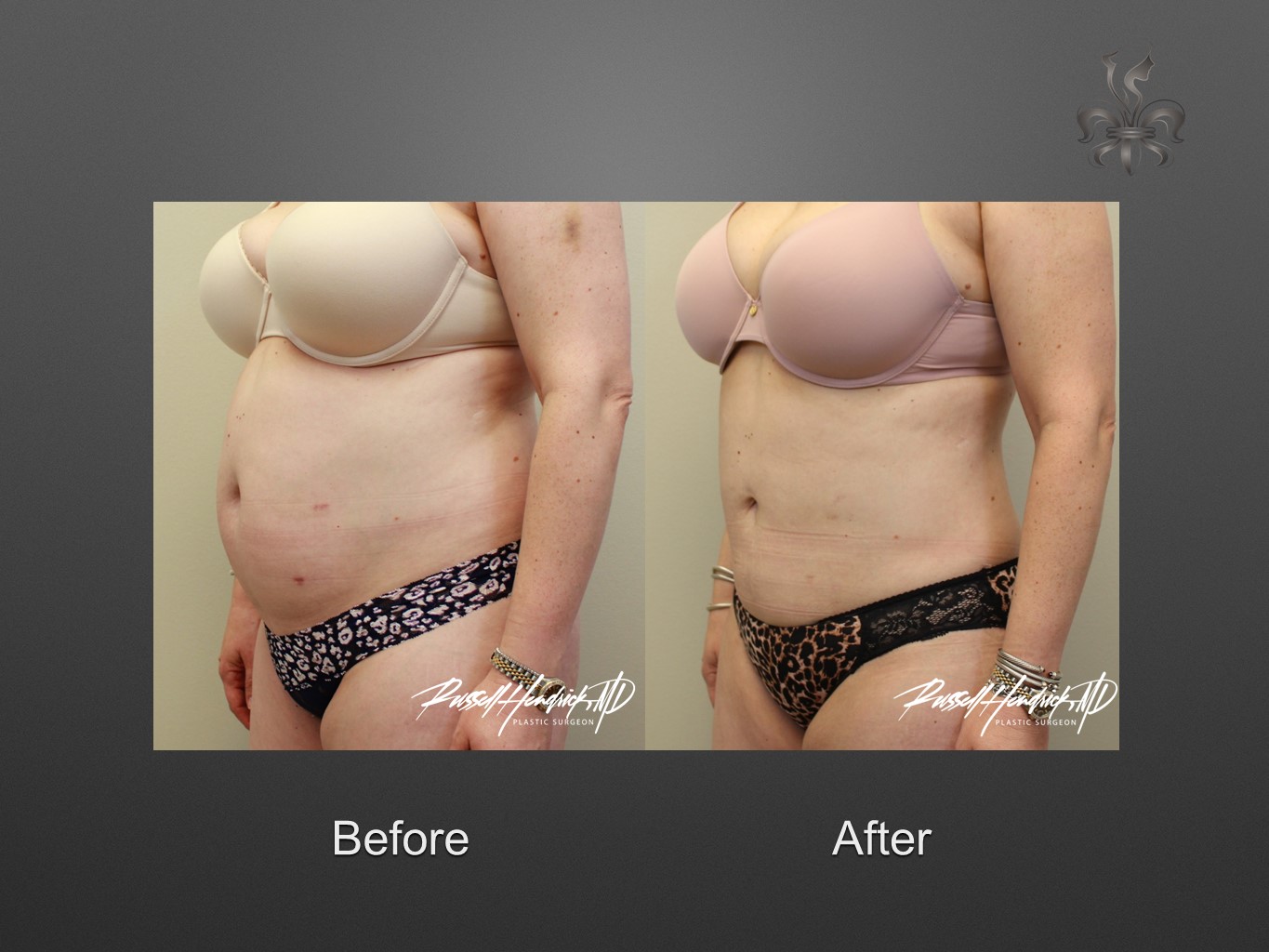 liposuction before and after