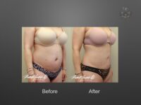 liposuction before and after