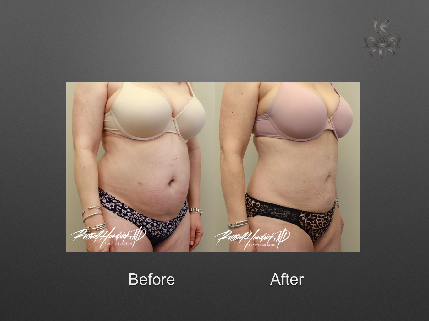 liposuction before and after