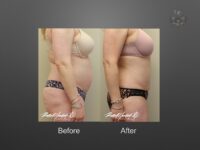 liposuction before and after