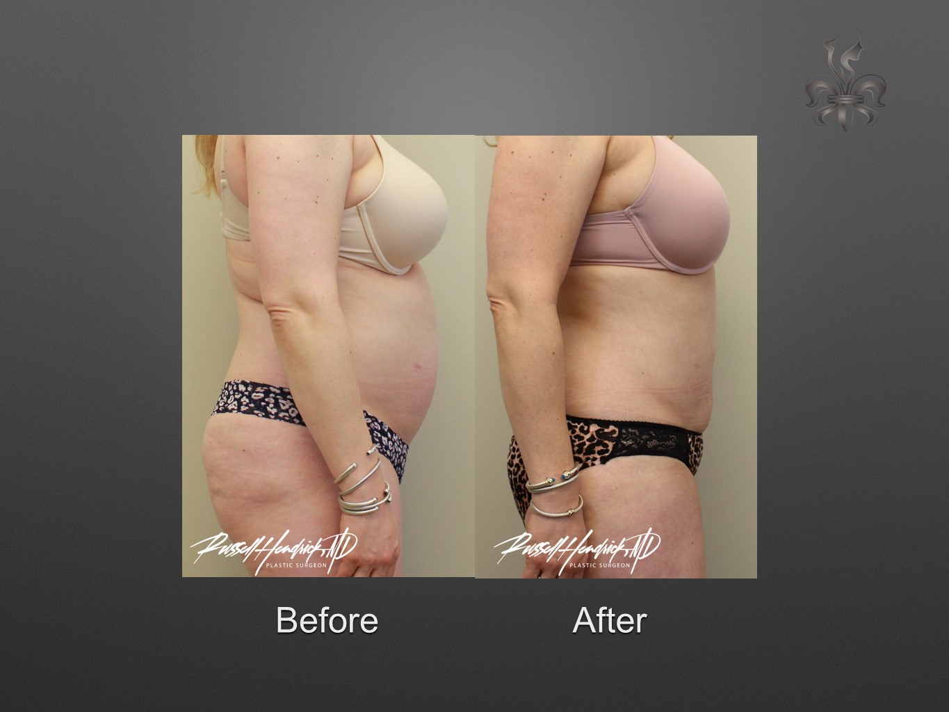 liposuction before and after