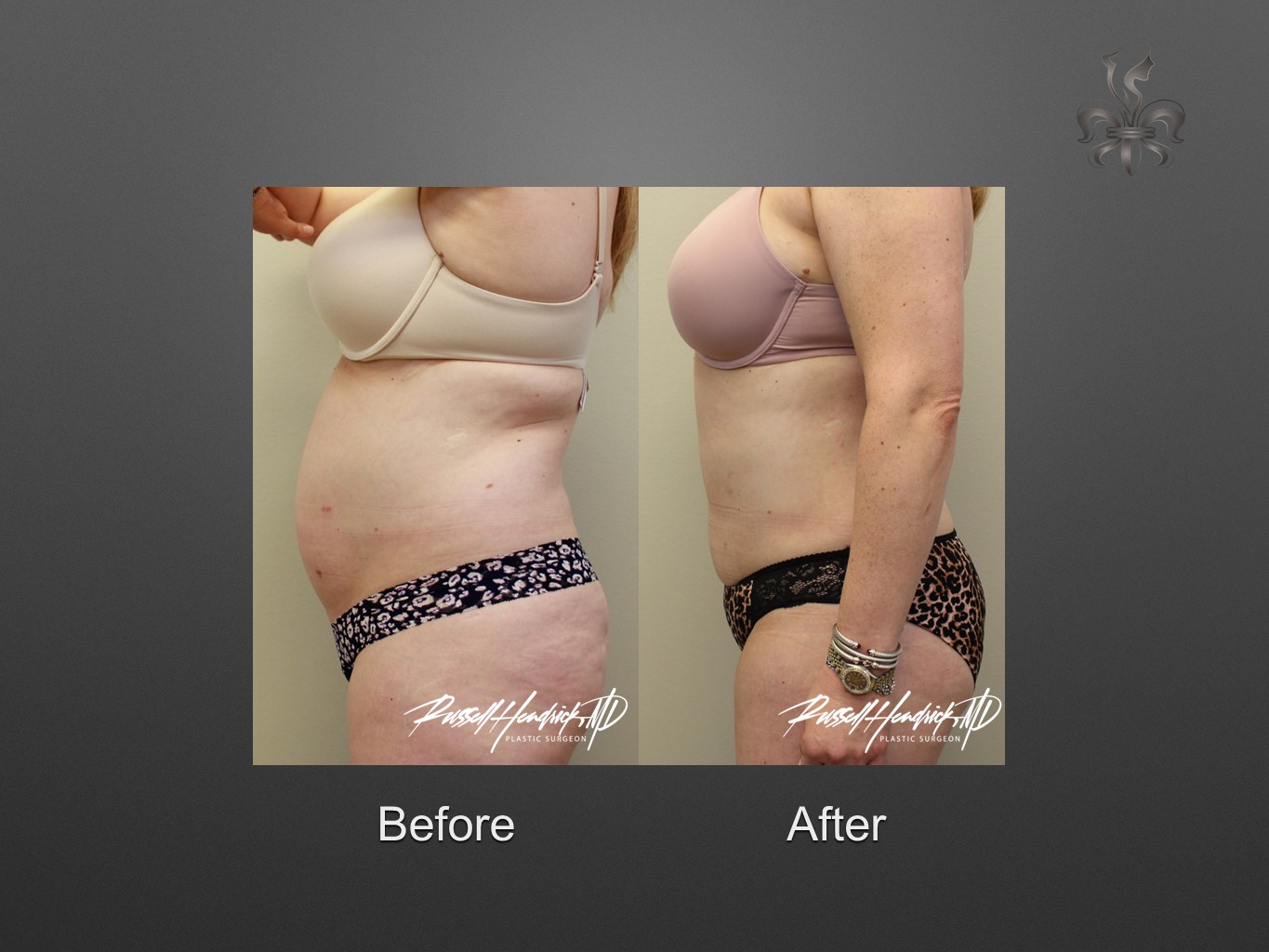 liposuction before and after