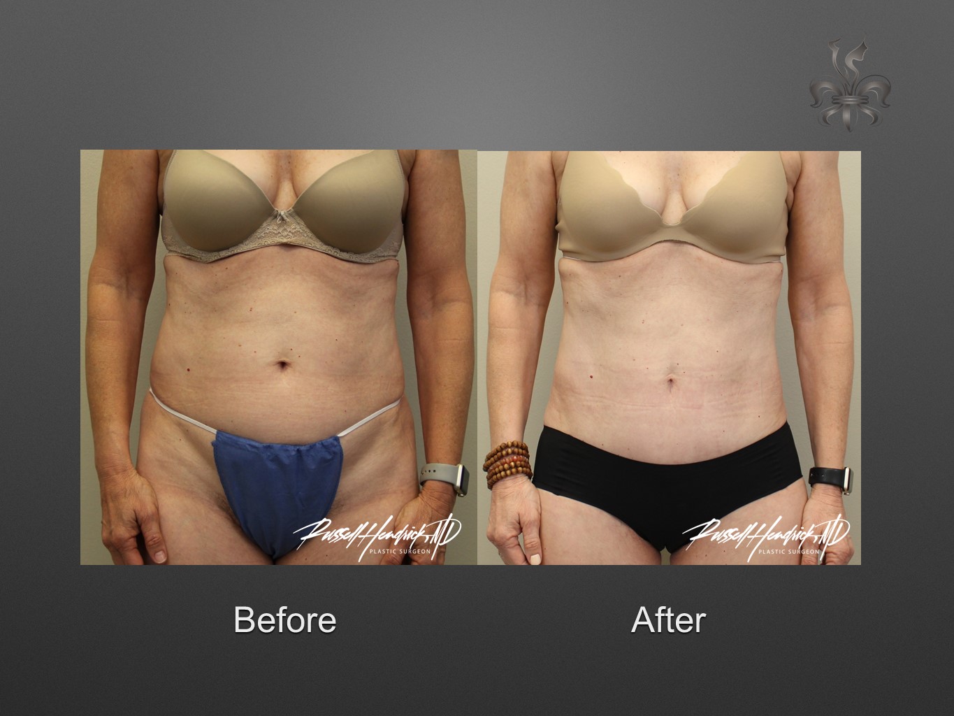 liposuction before and after