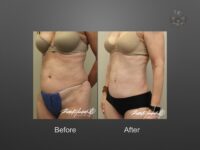 liposuction before and after