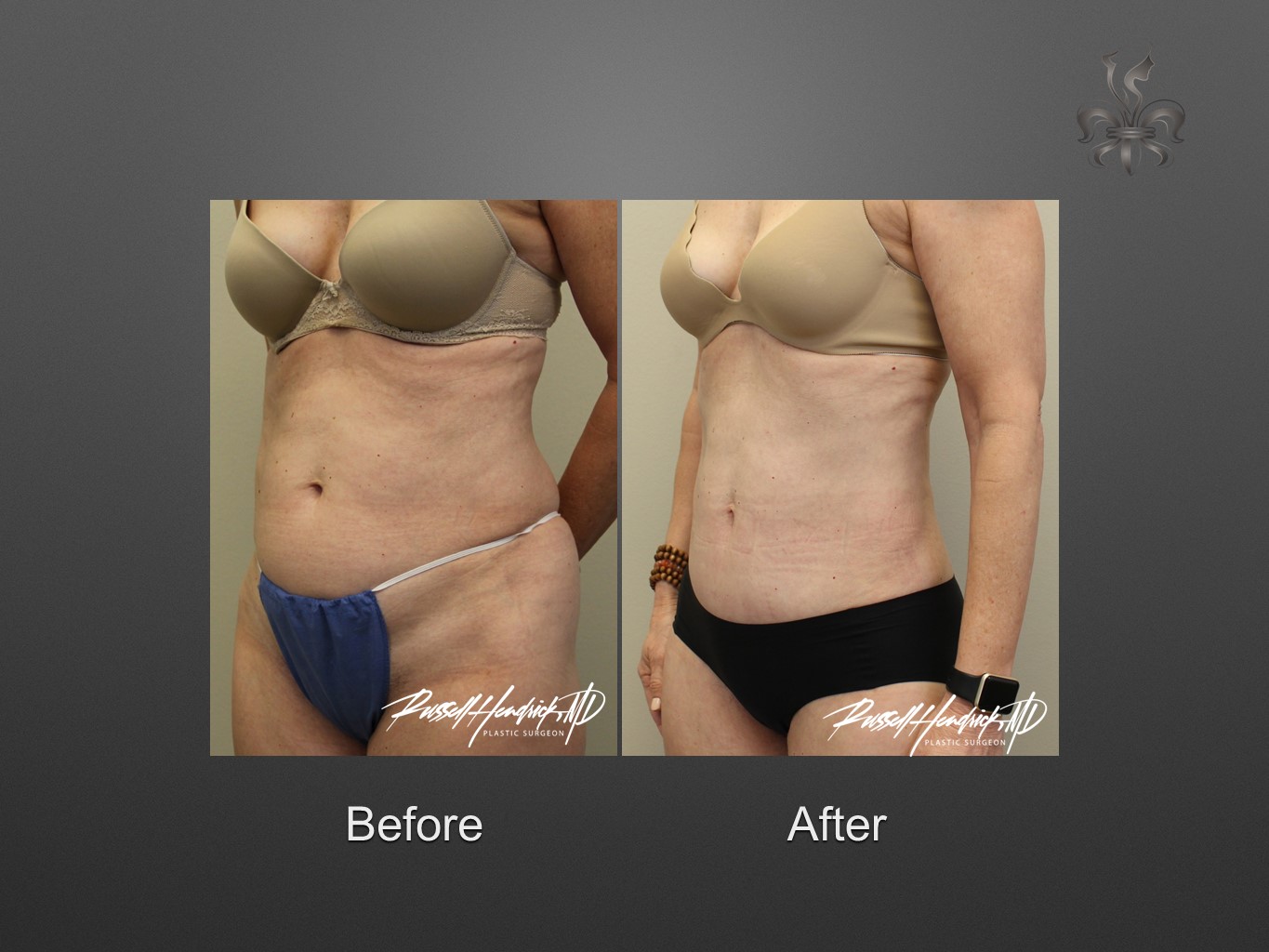 liposuction before and after
