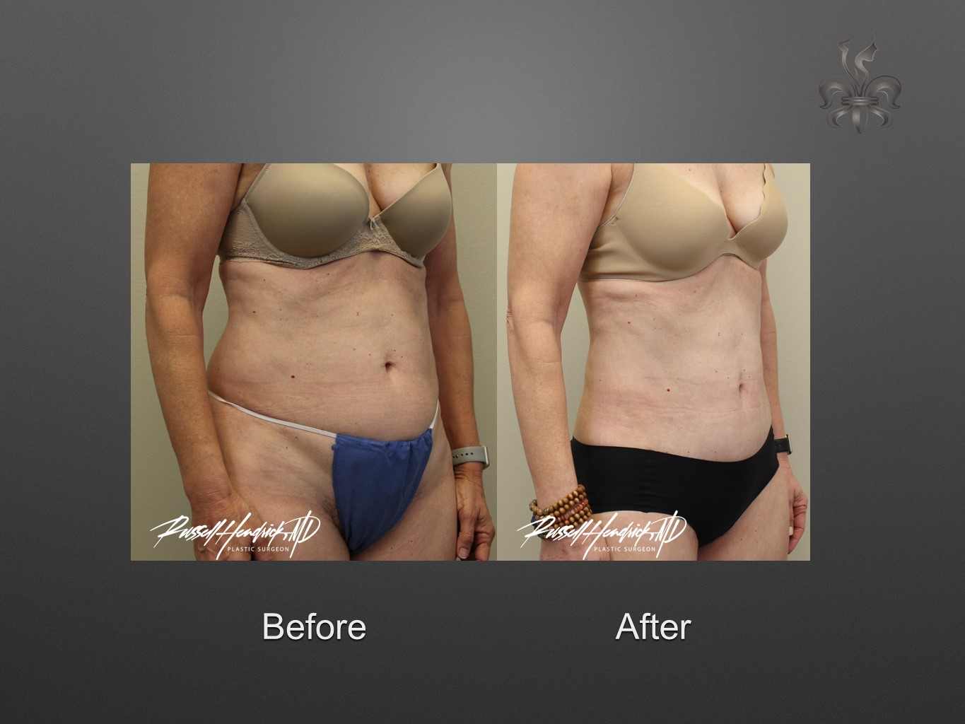 liposuction before and after