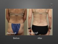 breast implant revision before and after