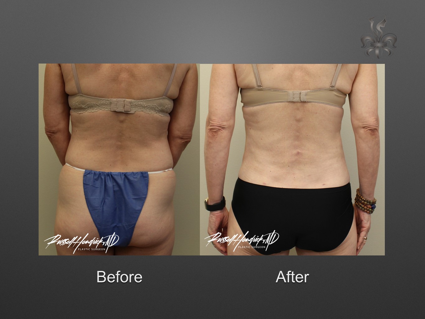 breast implant revision before and after