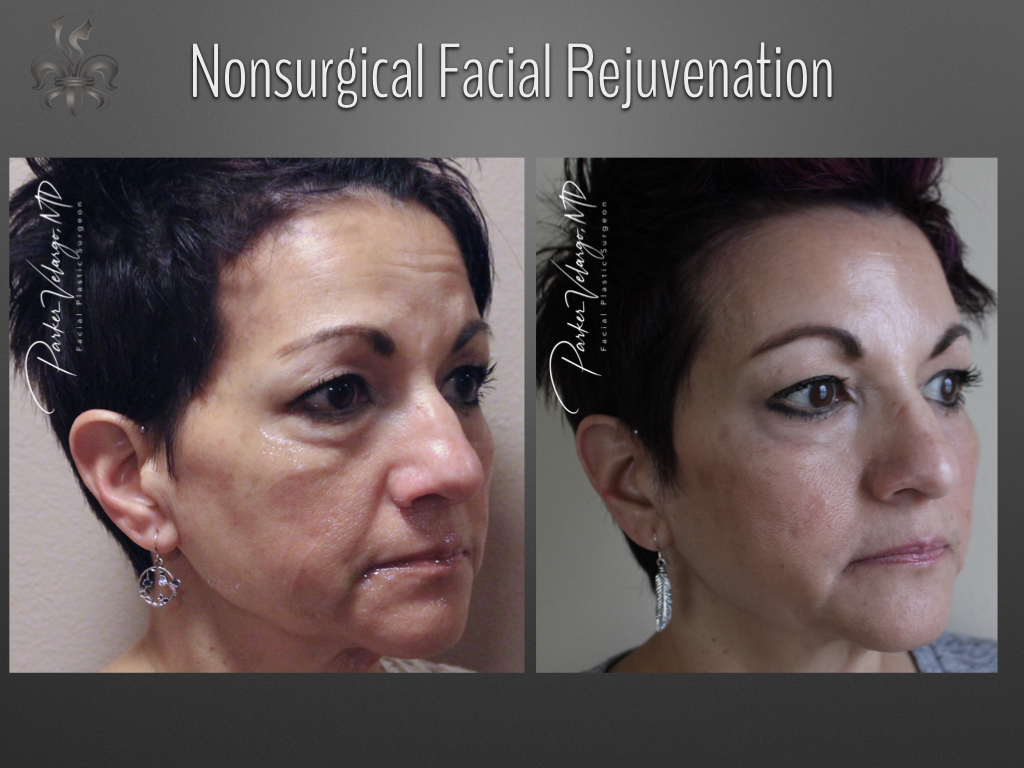non-surgical facelift before and after