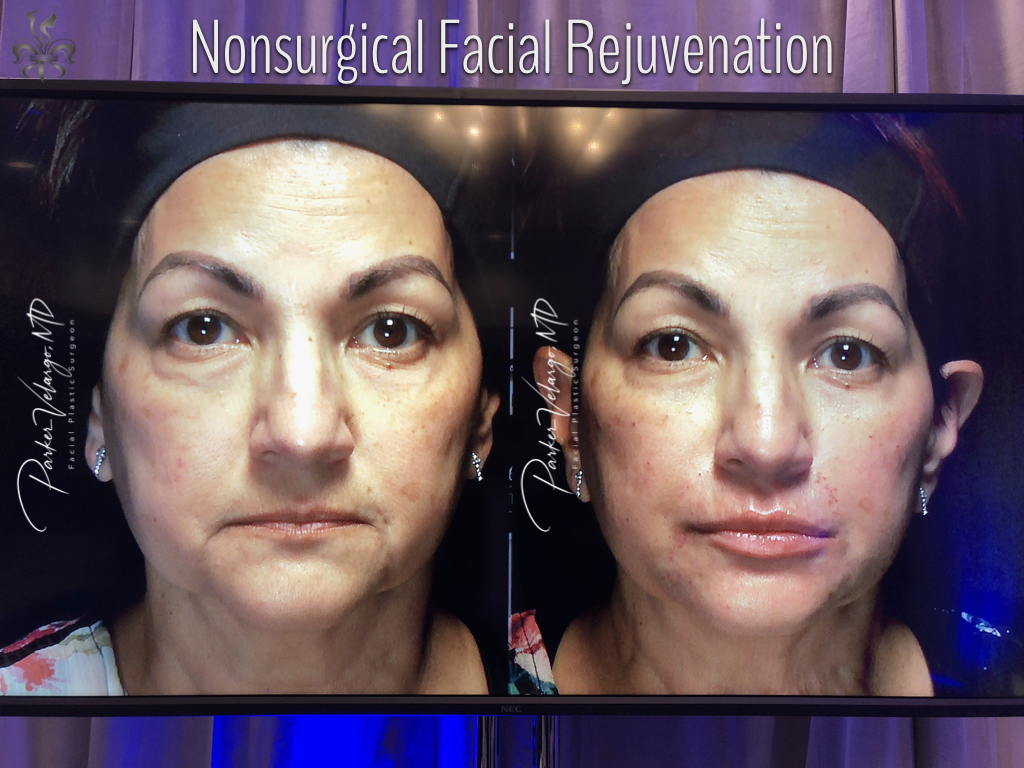 non-surgical facelift before and after