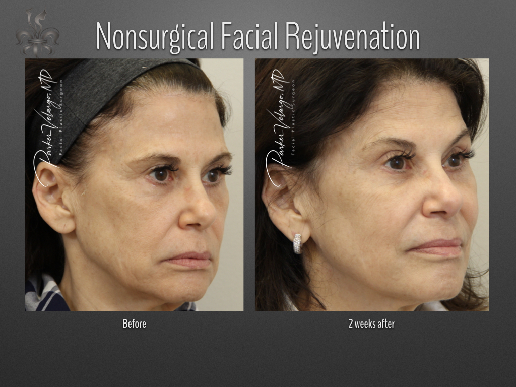 non-surgical facelift before and after